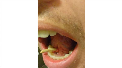 他照镜子时感觉舌头下有硬物,结果一用力挤出来一个奇怪的东西